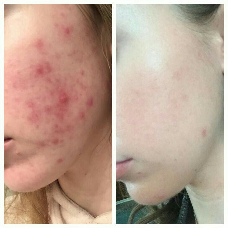 KORMESIC 10% Peroxyde de Benzoyle Gel Intensif Anti-Acné 30ml
